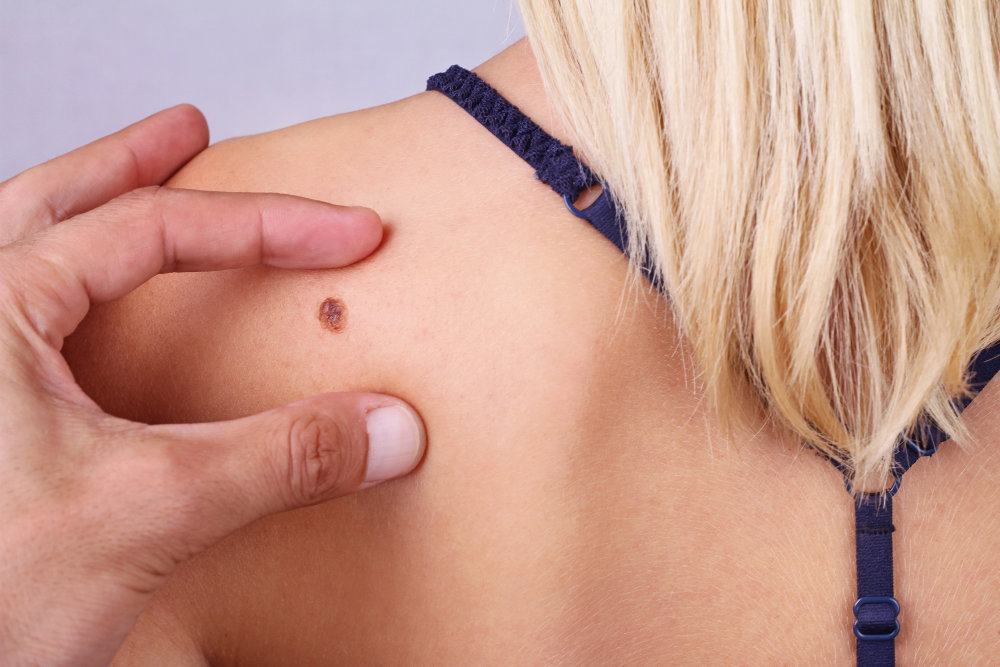 Dermatologist examining a mole on a patient’s shoulder in Burbank, CA