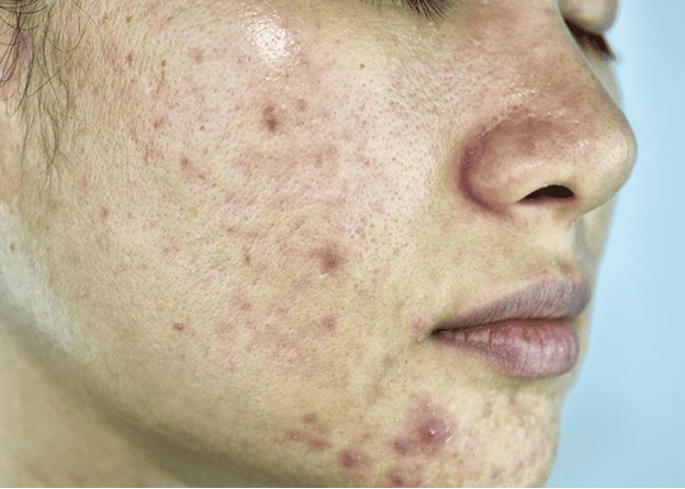 Patient with acne scarring including ice pick and boxcar scars on the cheek evaluating treatment options at Castle Dermatology in Encino